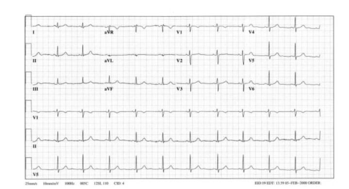 Figure 5 Actual Electrocardiogram output